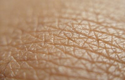 Manchester Cancer Research Centre - Melanoma and Other Skin Cancers