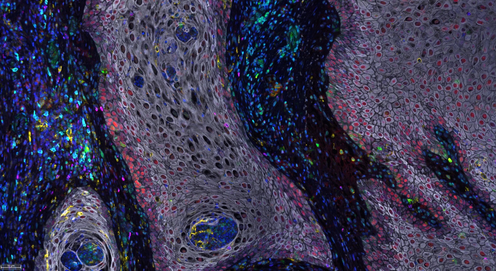 Image of penile cancer cells under the microscope