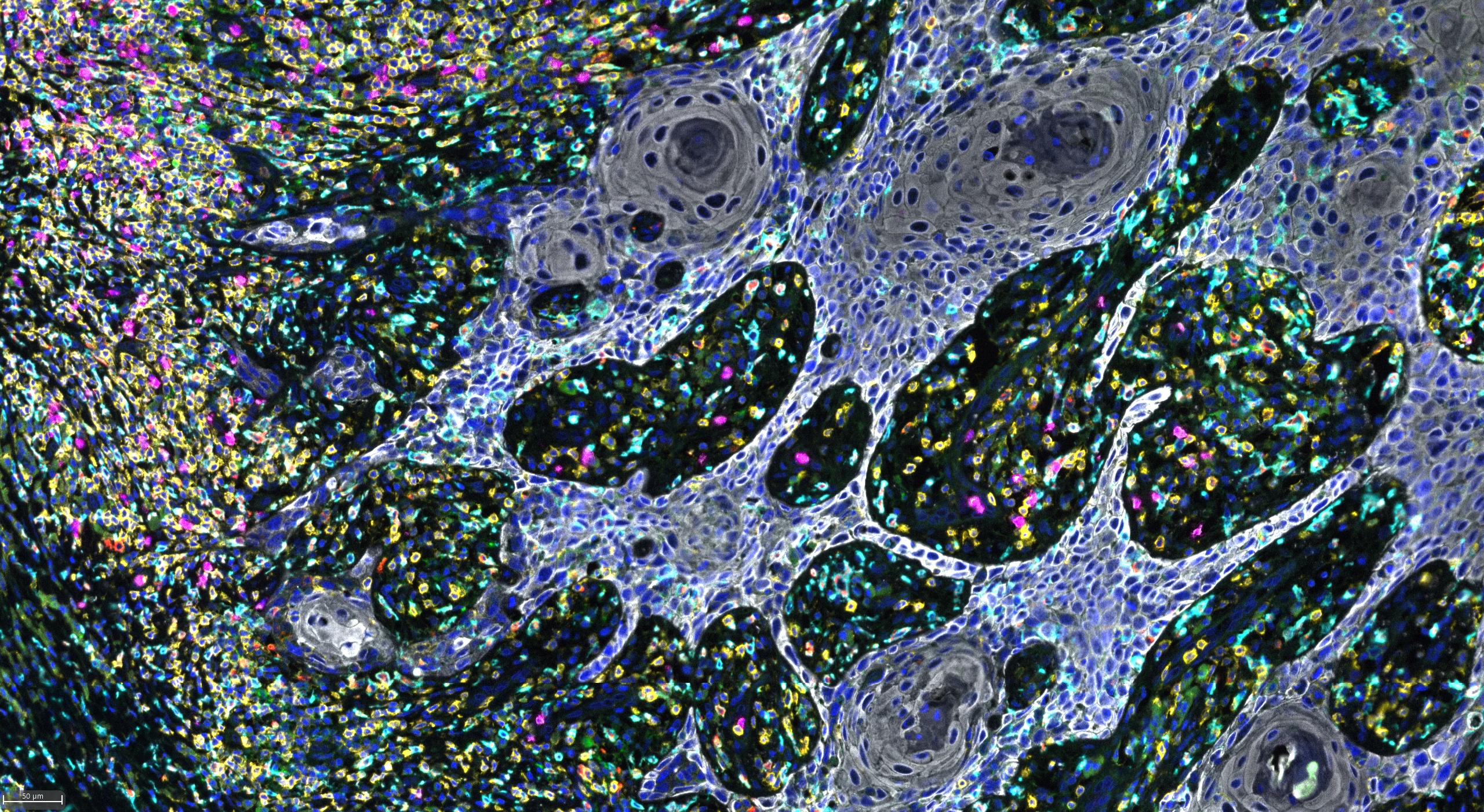 Stained Penile Cancer cells under the microscope