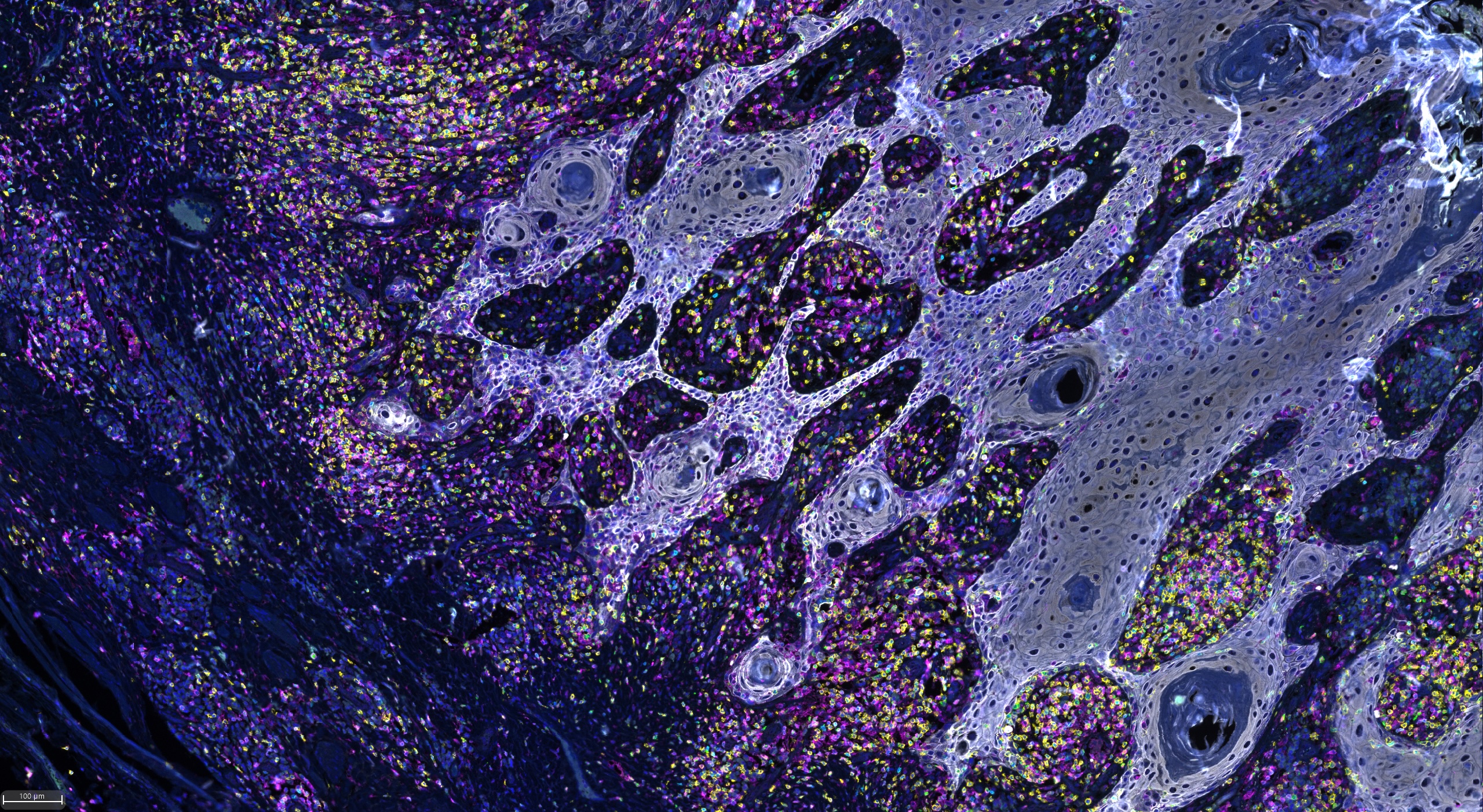 Stained Penile Cancer cells under the microscope