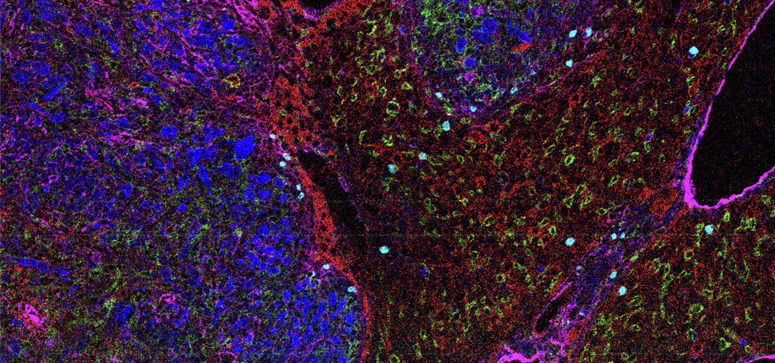Melanoma cell